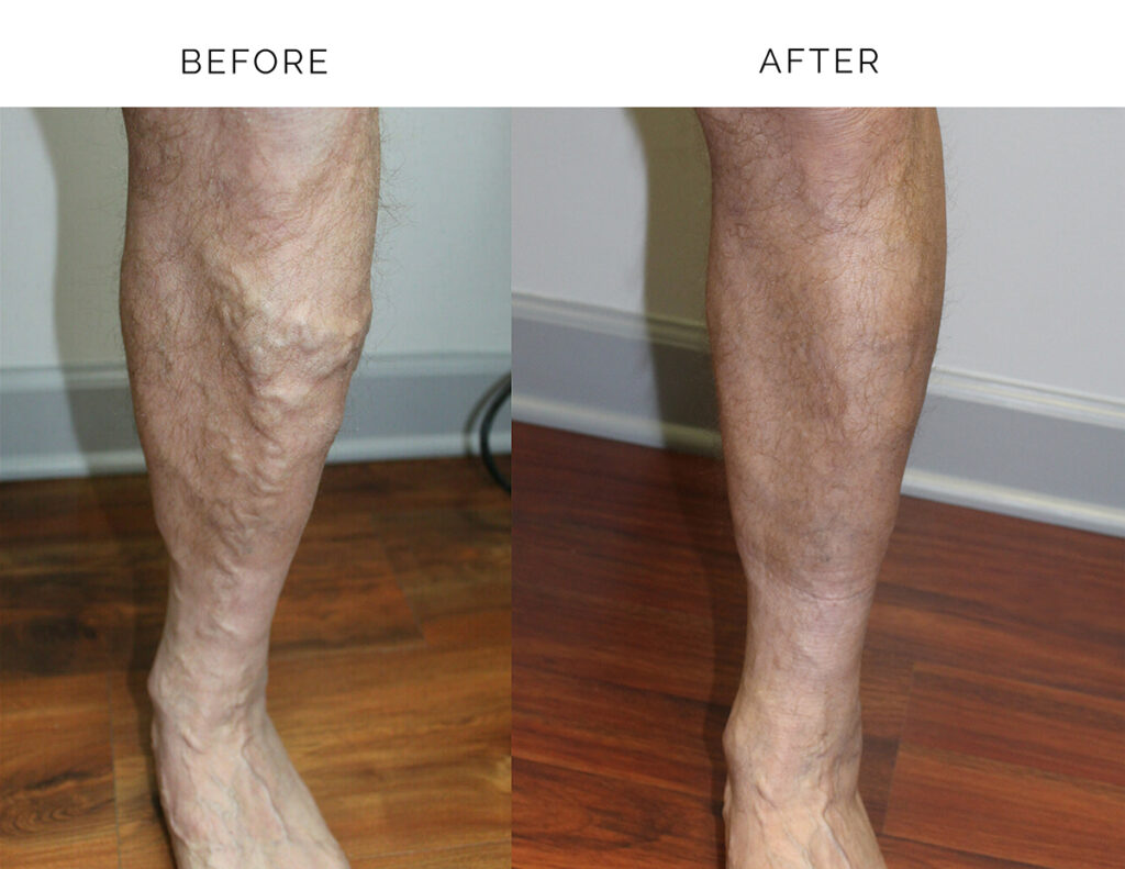 Varicose Veins Laser Treatment Addison Palos Hills Il Vein Expert