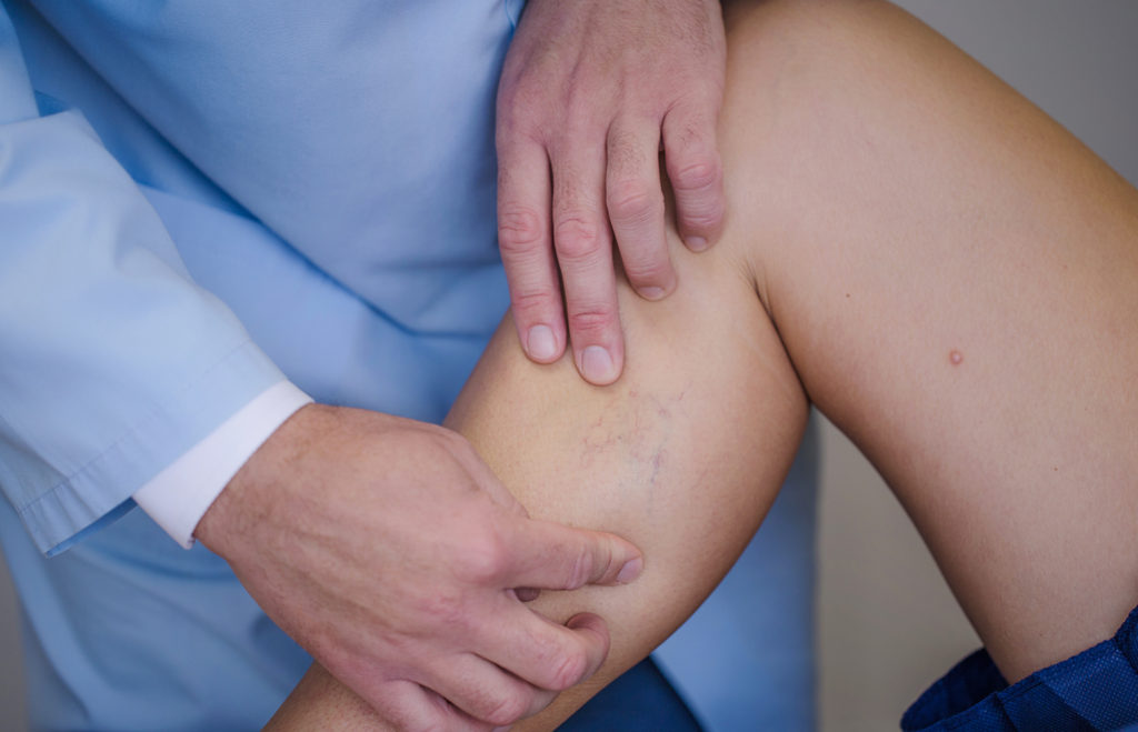 Spider veins evaluated by vein specialist