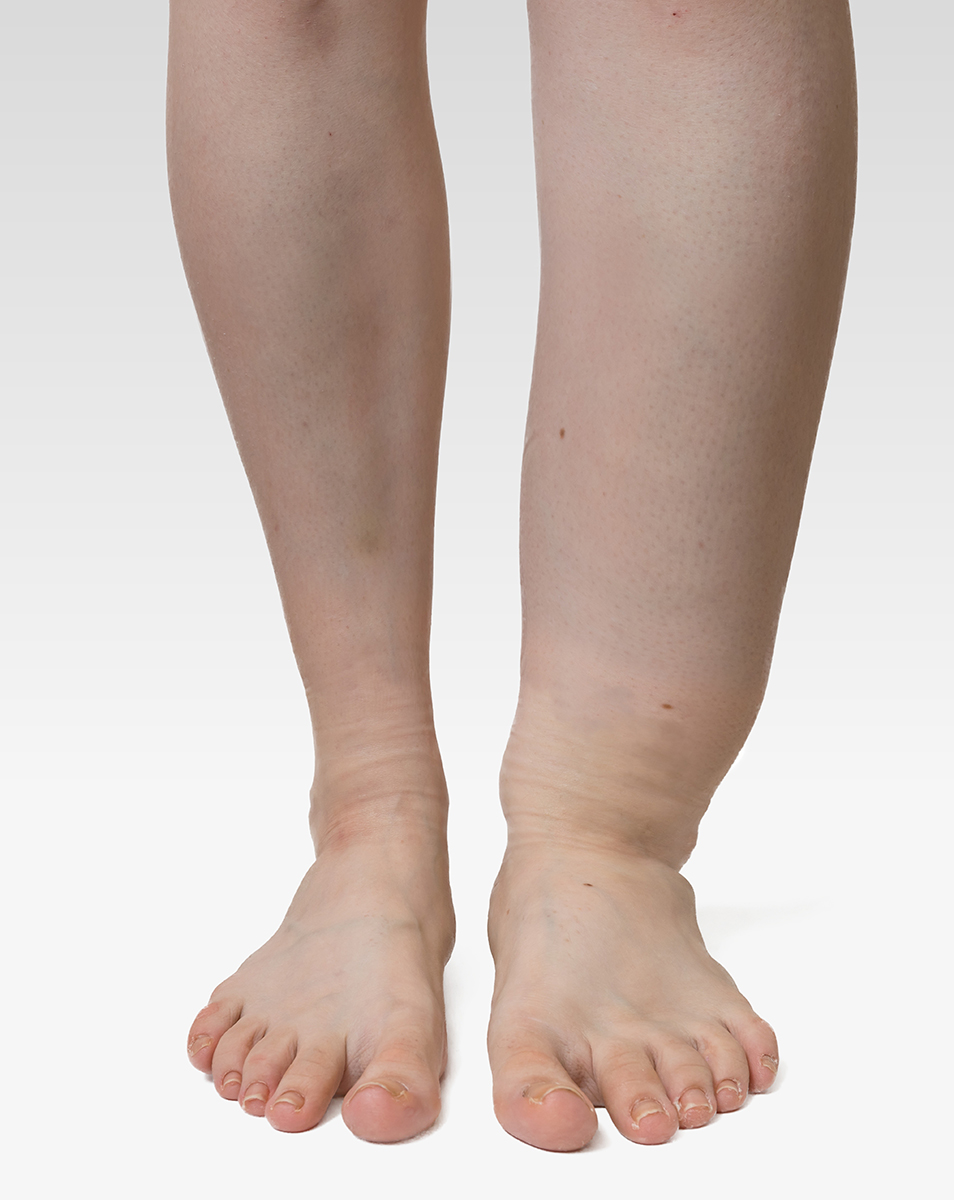 lump-on-calf-of-leg