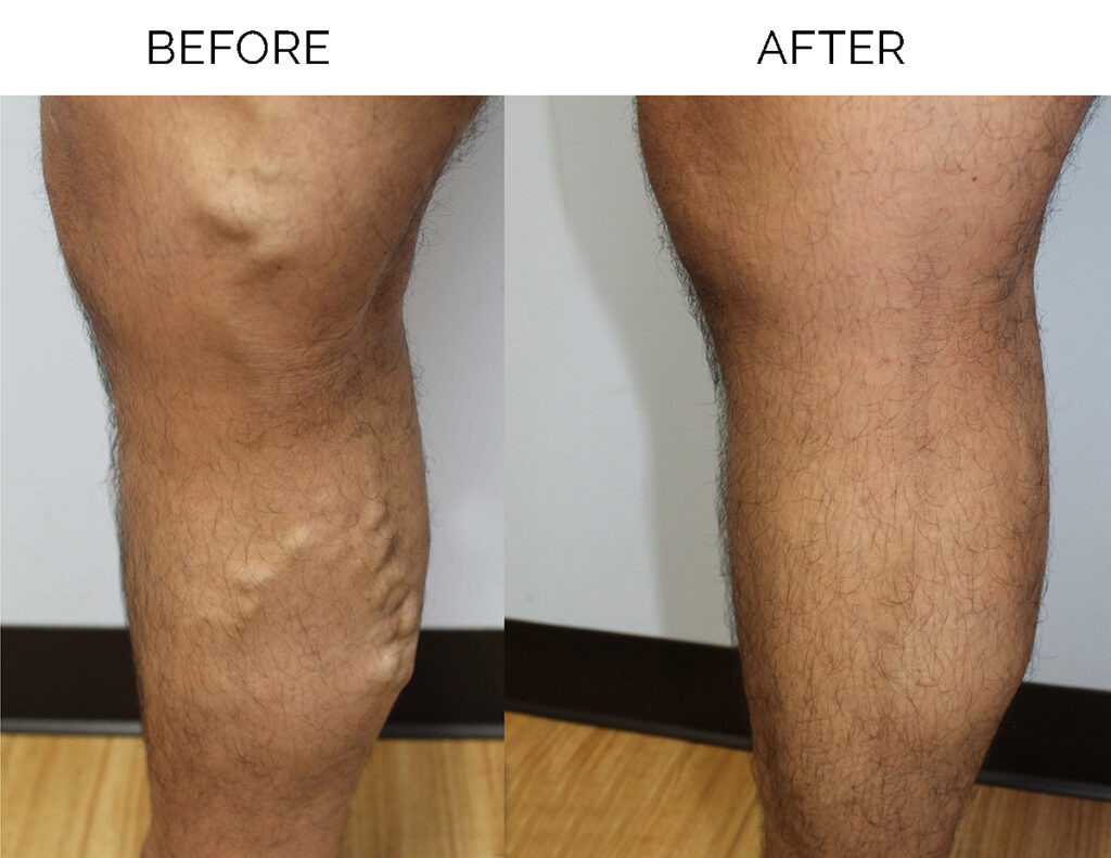 before and after photos after varicose veins laser treatment