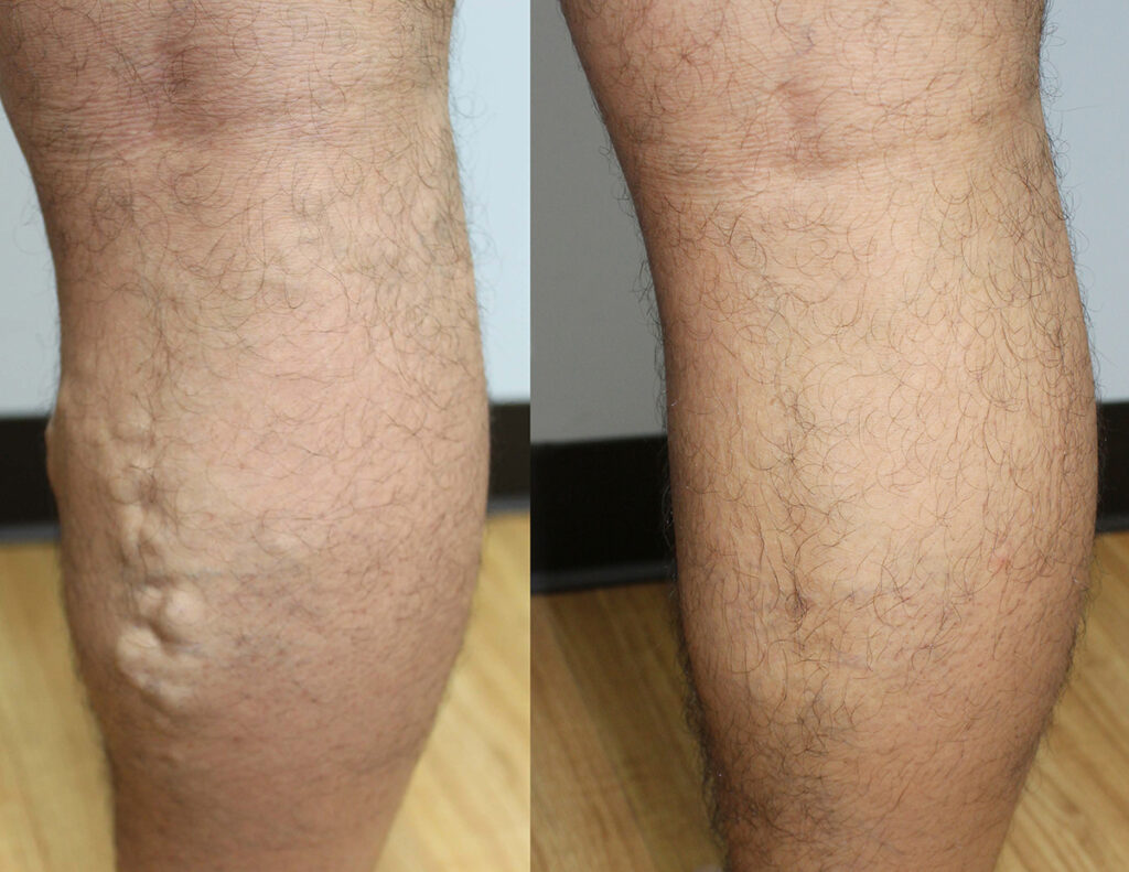 Varicose Veins Laser Treatment Addison & Palos Hills, IL | Vein Expert