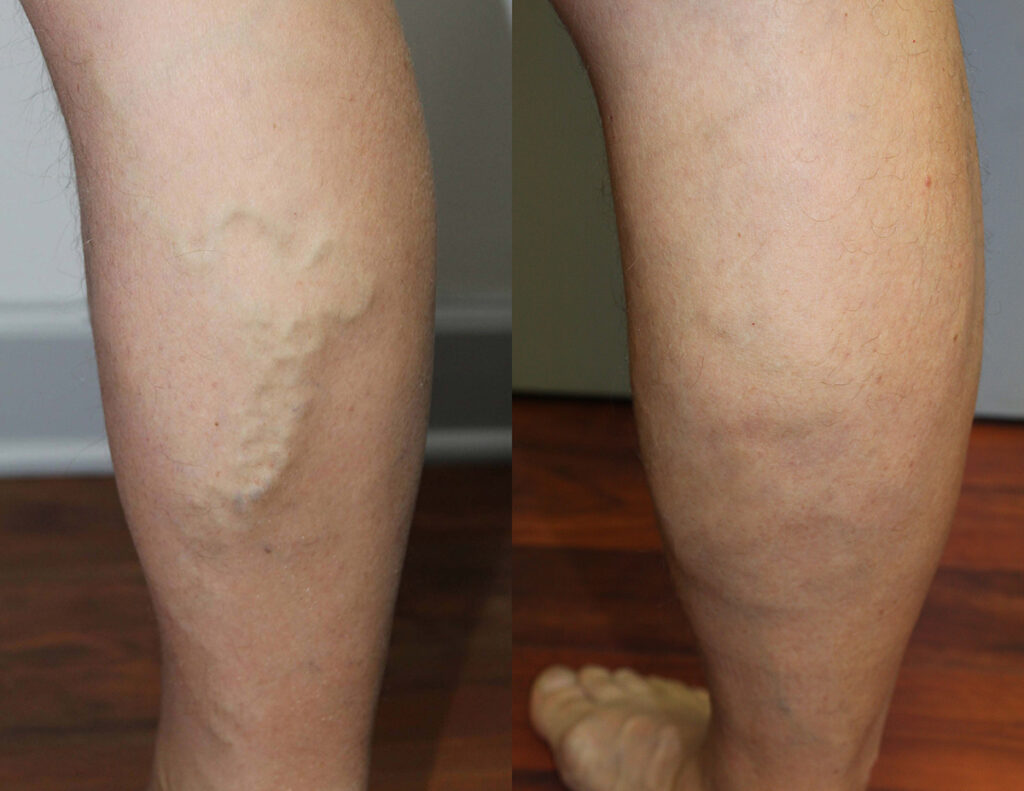 Varicose Veins Laser Treatment Addison & Palos Hills, IL | Vein Expert