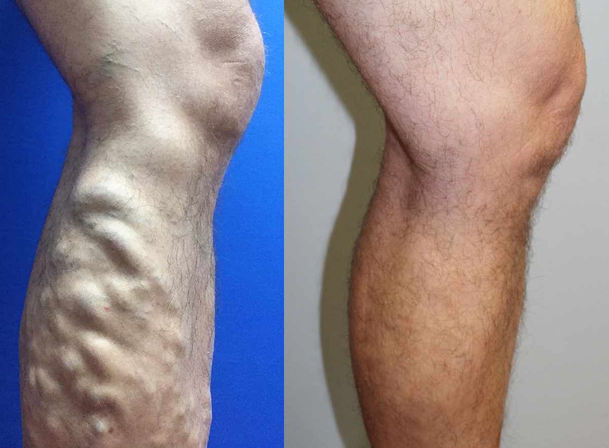 varicose veins before and after laser treatment - Peter Brukasz MD