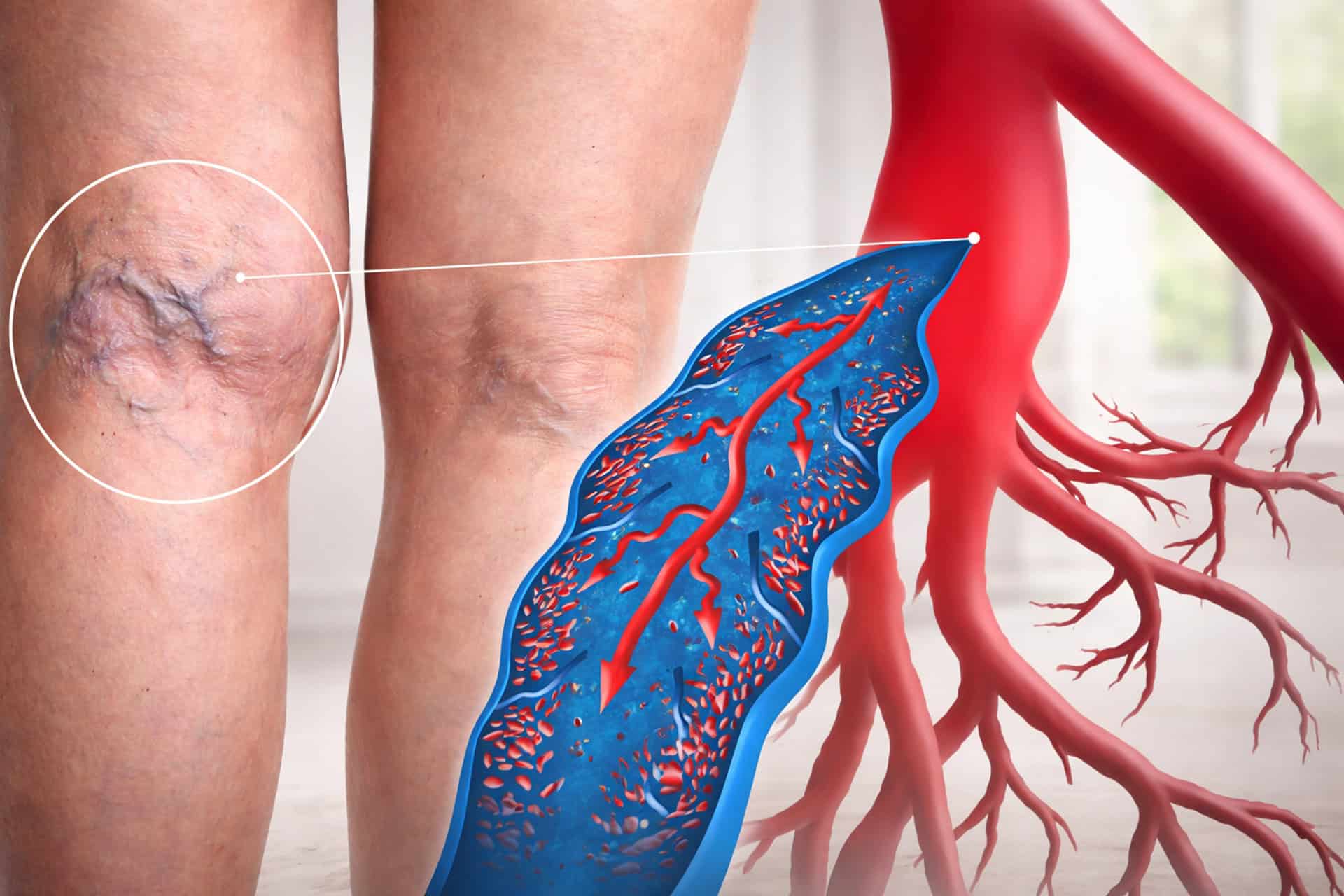 新品　VITA-K SPIDER VEINS クモ静脈の外観減、小じわ減少 Varicose and Spider Veins Specialists | Vein Clinic Schaumburg